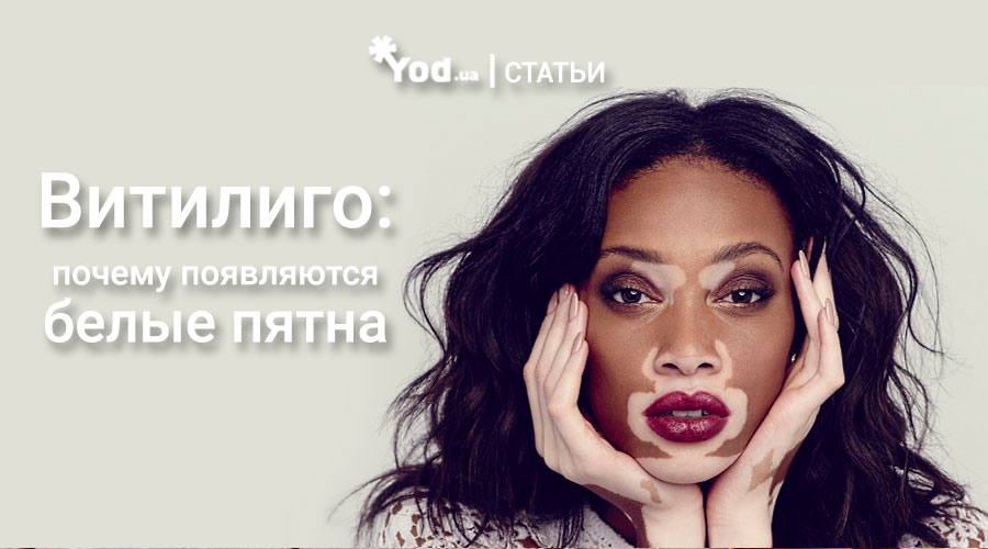 Витилиго: почему появляются белые пятна